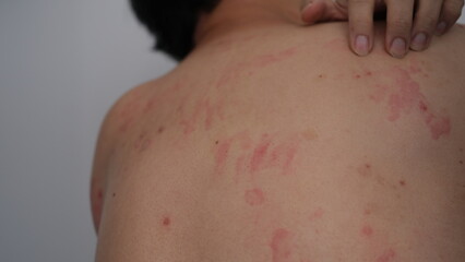 Close up image of skin texture suffering severe urticaria or hives or kaligata. Allergy symptoms.