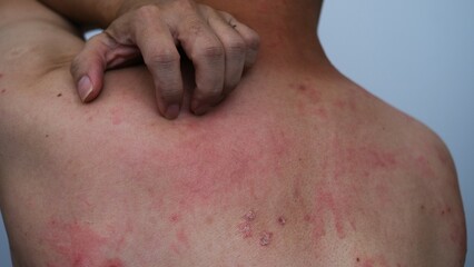 Naklejka premium Close up image of skin texture suffering severe urticaria or hives or kaligata. Allergy symptoms.