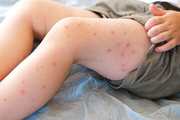 Child scratch body has sensitive itchy skin. Bodily rash. Kid allergy closeup. Little baby...