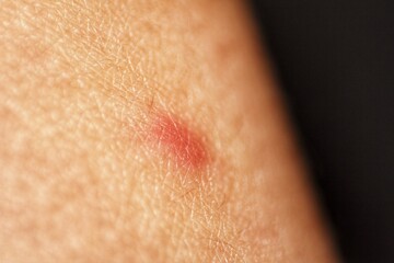 Close-up of a Red, Inflamed Skin Reaction Possible Insect Bite or Allergic Reaction