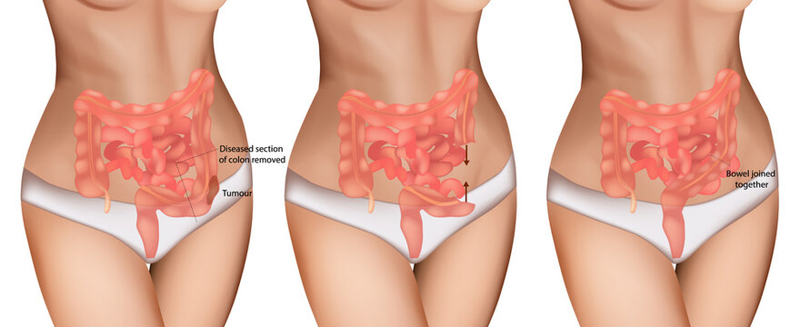 Colon Cancer Surgery Illustration &ndash; Tumor Removal and Bowel Reconnection. Medical Diagram of Colon Resection Procedure. Step-by-Step Colorectal Surgery with Tumor Excision and Anastomosis
