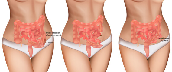 Colon Cancer Surgery Illustration – Tumor Removal and Bowel Reconnection. Medical Diagram of Colon Resection Procedure. Step-by-Step Colorectal Surgery with Tumor Excision and Anastomosis