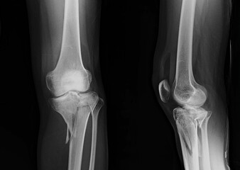x ray of a tibial plateu fracture knee
