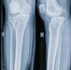 x ray of a tibial plateu fracture knee