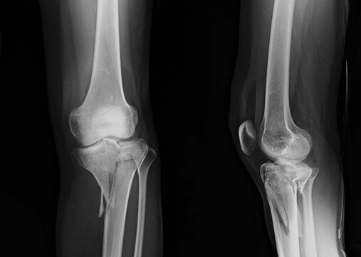 x ray of a tibial plateu fracture knee