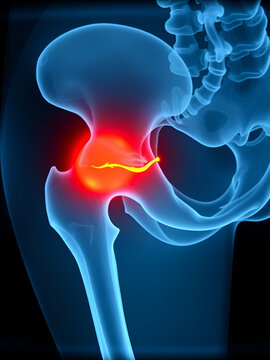 X-ray of inflamed hip joint highlighting avascular necrosis with a clear view of affected area, minimalist presentation emphasizing condition's seriousness and impact.