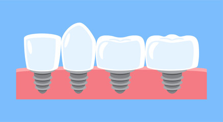 Dental implant . Type of teeth include incisor, canine, premolar and molar . Tooth cartoon illustration . Isolated on blue background . Flat design . Vector .