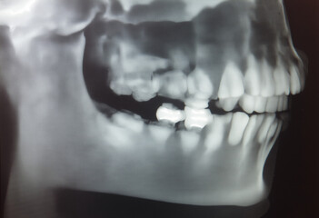Obraz premium Dental X-ray Showing Teeth and Jaw Structure in Black and White