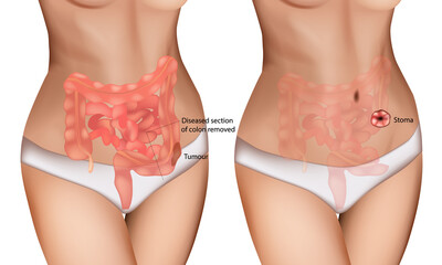 Colon Cancer Surgery and Stoma Formation Medical Illustration. Digestive Tract Tumor Removal with Colostomy Diagram. Colorectal Tumor Resection and Ostomy Procedure Anatomy