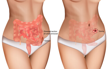 Colon Cancer Surgery and Stoma Formation Medical Illustration. Digestive Tract Tumor Removal with Colostomy Diagram. Colorectal Tumor Resection and Ostomy Procedure Anatomy