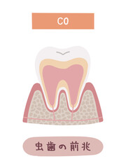 虫歯になる過程のC0のイメージイラスト