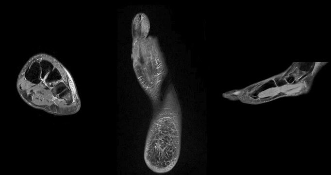 MRI foot scan for a diagnostic of the foot and ankle following symptoms: pain  both feet, swelling, redness or warmth, numbness or tingling and stiffness.