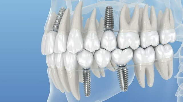 Teeth recovery with dental implant, transparent view. Medically accurate 3D Animation