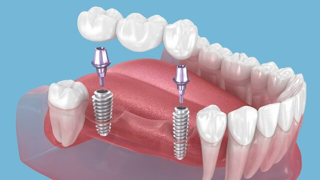 Dental bridge based on two implants. Medically accurate 3D Animation of human teeth and dentures concept