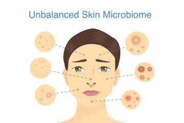 Woman's face is covered with many types of acne because Unbalanced Skin Microbiome. Illustration about Skin Microbiome and not have enough probiotics.