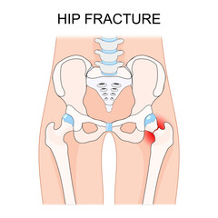 Hip fracture. Bones of hip joint