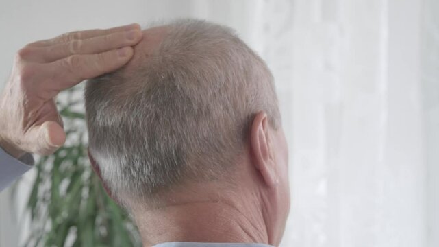 Rear view older man with bald patches on scalp, showing signs alopecia and age-related hair thinning, Anti-aging treatments for balding men, hair loss