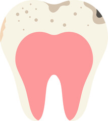 A vector illustration of an infected, decayed tooth showing visible damage and poor oral health. Perfect for dental care, medical education, or awareness about tooth infections.