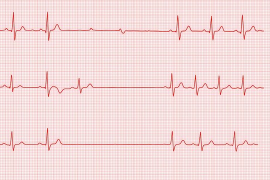 high-resolution ecg waveform illustrating irregular heart rhythms on standard red graph paper, useful for cardiology education, diagnostics, and healthcare visuals