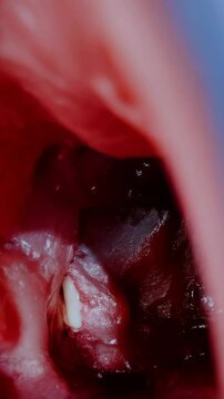 Detailed view of an ear canal showcasing eardrum with graft and drainage, displaying medical procedure close-up