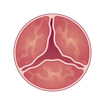 Medical illustration shows aortic valve with stenosis. Vector illustration