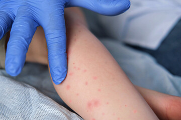 Doctor examining child with bodily red rash. Kid allergy closeup. Little baby scratches an...