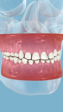 Dental attrition (Bruxism) resulting in loss of tooth tissue. Dental 3D animation
