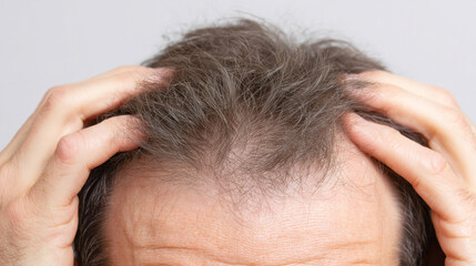 Fototapeta premium Top view of head with fingers touching area of thinning hair, visible receding pattern near front hairline, soft shadows on white background, focus on realistic hair loss