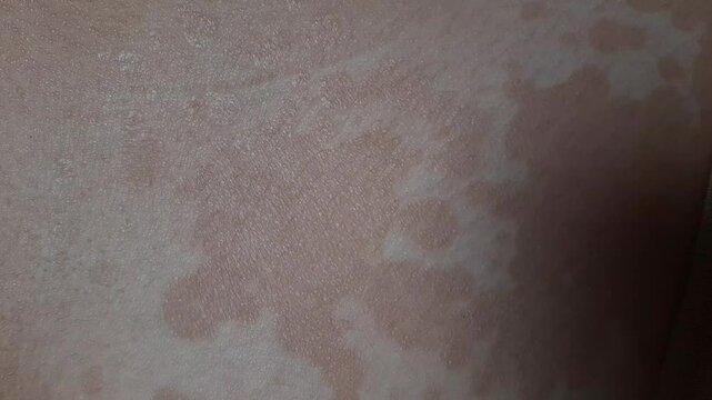 brown spot skin fungal infection	
