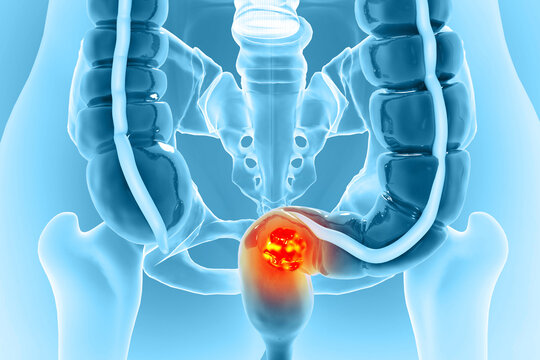 Colon cancer. Cancer attacking cell. Colon disease concept. 3d illustration