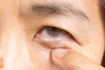 Obraz premium Senior woman has cataract. Generally, cataracts are common in older people.