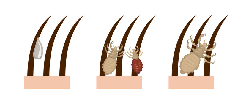 Lice clinging to hair and special medicine dropping on it
