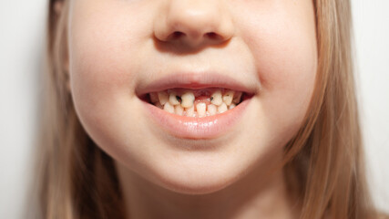 Close-up of girl showing decayed teeth due to lack of hygiene