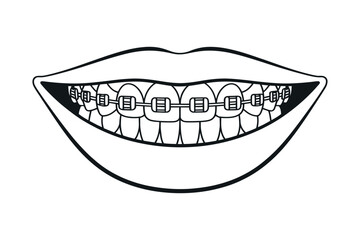 Smiling Mouth with Orthodontic Braces Illustration