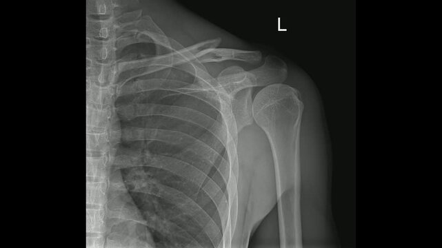 Left Shoulder X-ray Showing Clavicle Fracture , Scapula, and Humerus in Anteroposterior View