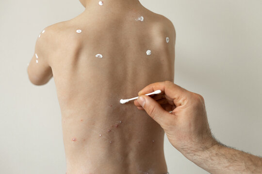 Father applies soothing cream for son&acirc;&euro;&trade;s chickenpox rash