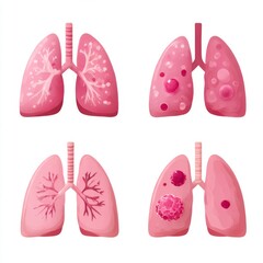 Lung health illustrations showing different conditions in a clear educational display