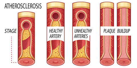 stages of atherosclerosis. Atherosclerosis formation Healthy artery and unhealthy arteries.