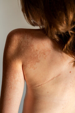 Heart surgery scar and skin pigment spots on female back