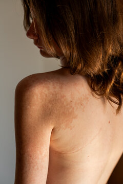 Heart surgery scar and skin pigment spots on female back