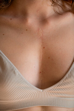 Heart surgery scar on skin of woman close up