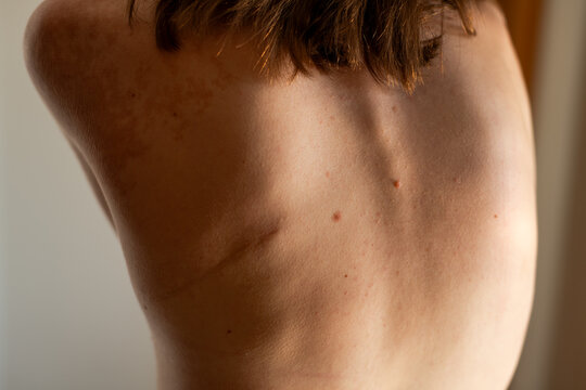 Heart surgery scar and skin pigment spots on female back