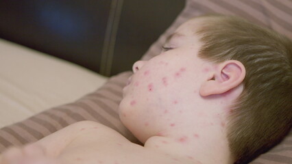 A Child with an Acne Skin Condition chickenpox Lying Down Comfortably on a Pillow in the Bedroom