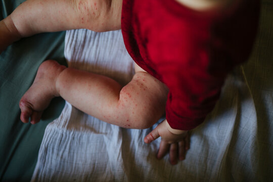 Low section of baby with skin allergy sitting on bed