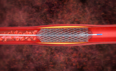Balloon angioplasty procedure with stent in vein
