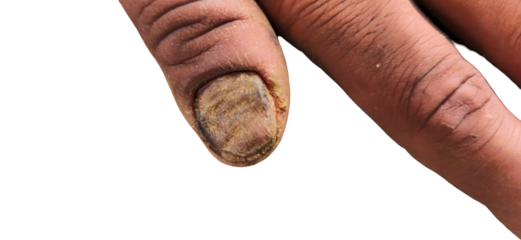 Fungus Disease on Nails PNG Isolated on White Background