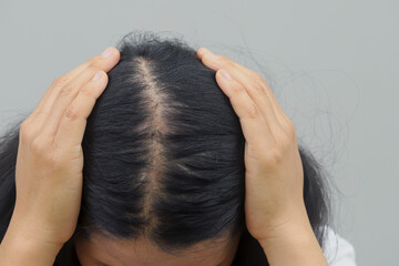 Naklejka premium Women with hair loss dryness and frizziness.