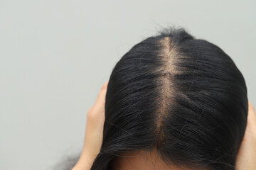 Women with hair loss dryness and frizziness.