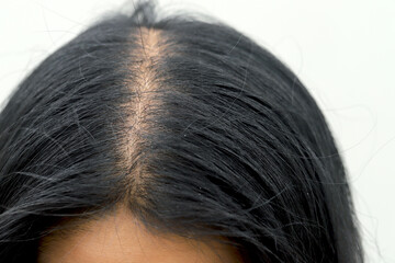 Women with hair loss dryness and frizziness.