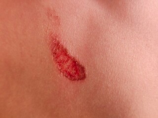 Fototapeta premium Skin injury showing redness and swelling indicating possible abrasion on the body skin surface concept